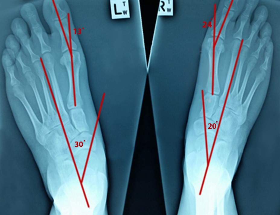 How to Avoid Bunion Surgery Gold Coast Podiatrist