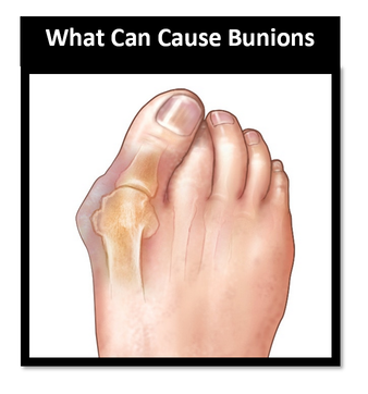 Podiatrist for bunions on the Gold Coast